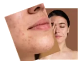 Clinical Acne & Skin Glow Transformation Result