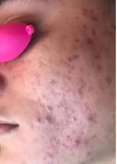 Before Treatment